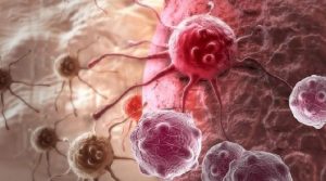 جوان افراد میں تیزی سے عام ہونیوالے آنتوں کے کینسر کی 5 علامات جانیں