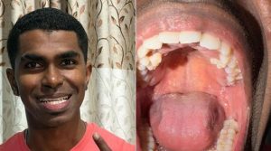 ملائیشیا سے تعلق رکھنے والا شخص جس کے منہ میں 42 دانت ہیں