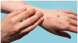 کراچی میں رواں سال منکی پاکس کا پہلا کیس رپورٹ