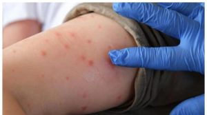 کراچی میں بچوں میں خسرہ، چکن پاکس اور ممپس کے کیسز میں اضافہ، علامات کیا ہیں؟