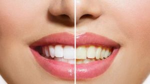 دانتوں کی سفیدی بحال کرنے میں مددگار آسان ٹپس