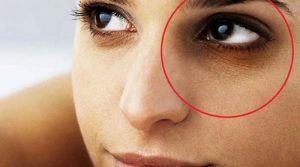 کیا آنکھوں کے نیچے سیاہ حلقے کسی بیماری کا نتیجہ ہوسکتے ہیں؟